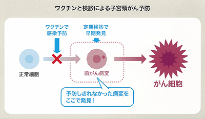 ワクチンと検診による子宮頸がん予防